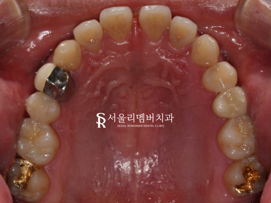 벌어진 치아, 사당 치과 인비절라인으로 개선할 수 있을까? 관련 이미지 5