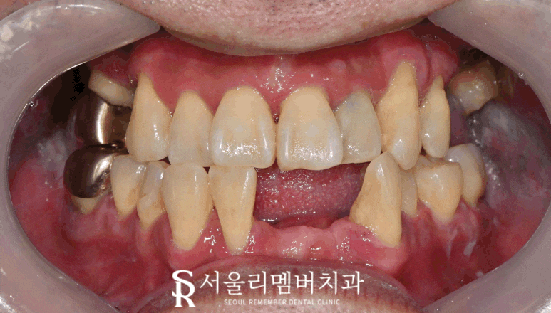 서울대입구역 치과 발치 즉시 다수 네비게이션 임플란트 식립 결과는? 관련 이미지 5