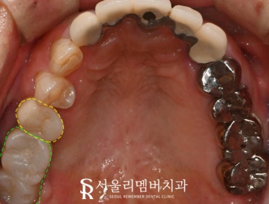 서울대입구역 치과 임플란트, 신경치료 크라운, 인레이 모두 해야 된다면 어떤 진료부터 시작해야 될까요? 관련 이미지 6