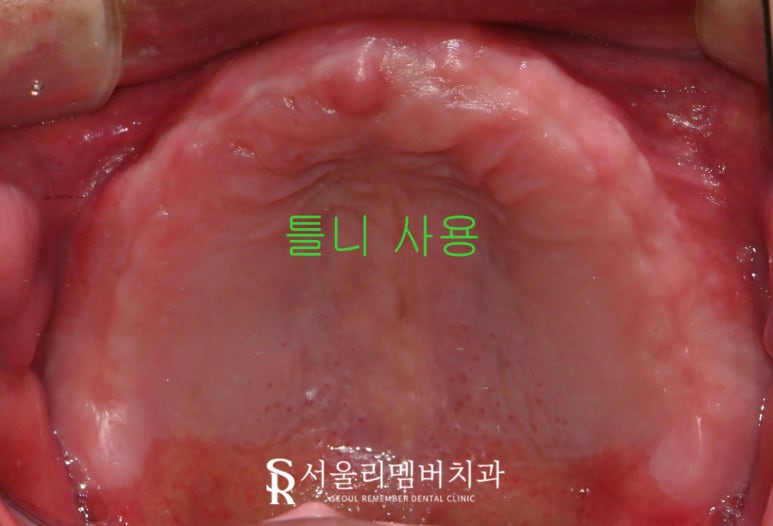 임플란트로 구강환경개선 신림역 치과 에서 깔끔하게 치료한 케이스 관련 이미지 2
