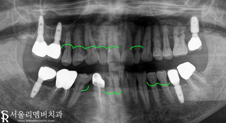 상도동 치과 다수의 충치, 임플란트와 신경치료 한 사례 (치경부 치석 관리의 중요성) 관련 이미지 2