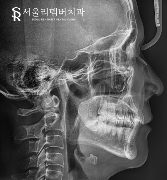 40대 교정 지금 시작해도 늦지 않을까요? 서울대입구역 치과 관련 이미지 1