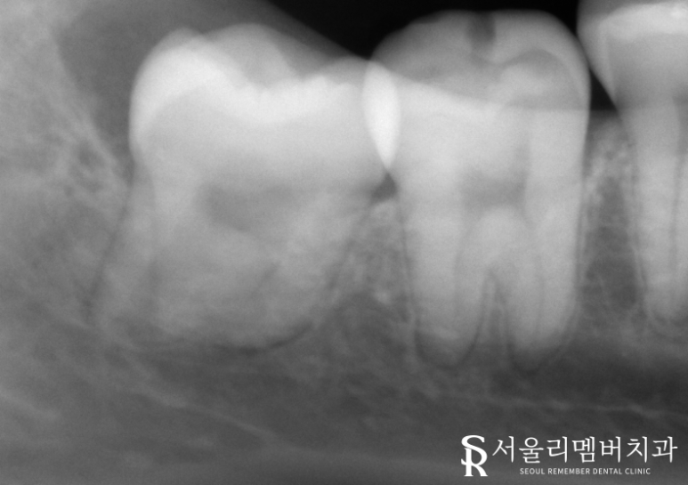 영등포 치과 대학병원 가지 않고 매복니 뽑을 수 있을까요? 관련 이미지 2