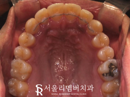 서울대입구역 치과 에서 들쑥날쑥 했던 치열, 비발치로 개선해 드렸습니다. 관련 이미지 8