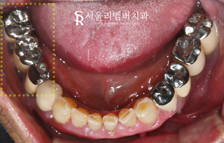 임플란트 및 크라운 으로 구강 환경 개선하는 방법 - 서울대입구역 치과 관련 이미지 1