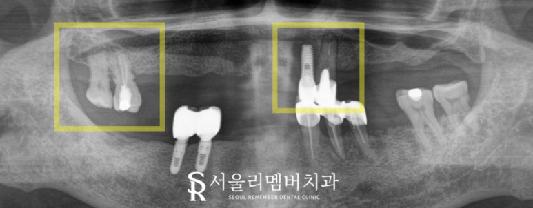 서울대입구역 치과 나에게 맞는 보철은 틀니? 임플란트? 관련 이미지 3