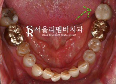 봉천동 치과 임플란트 치료 과정, 어금니가 없어서 식사가 어려워요. 관련 이미지 9