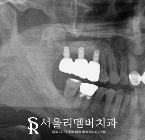 봉천동 치과 임플란트 치료 과정, 어금니가 없어서 식사가 어려워요. 관련 이미지 6
