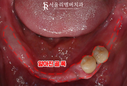 신대방 치과 고난도 전악 임플란트 수술 가능 관련 이미지 2