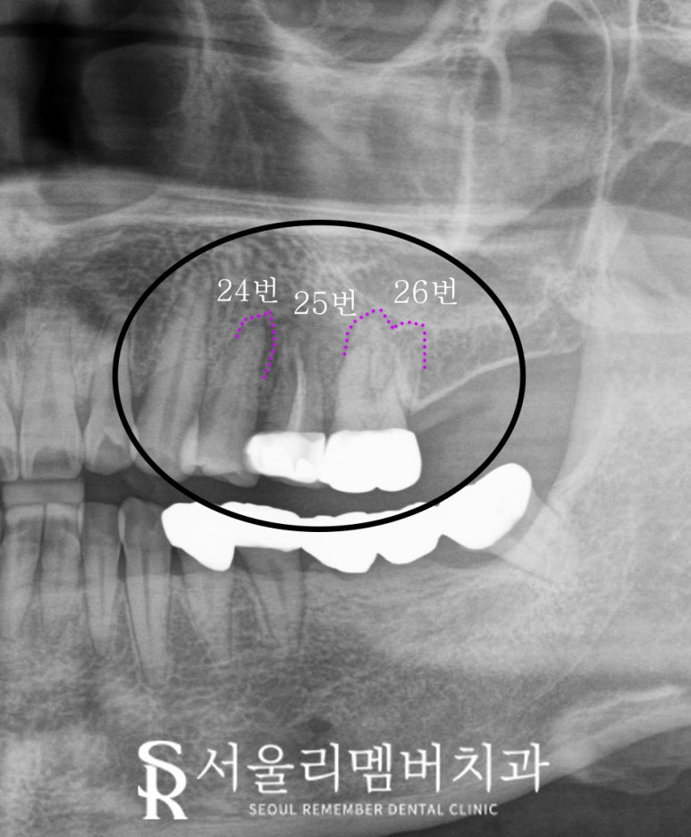 봉천역 치과 어금니 보철 후 음식물 끼임 및 치아 파절, 신경치료 크라운 및 임플란트 관련 이미지 3