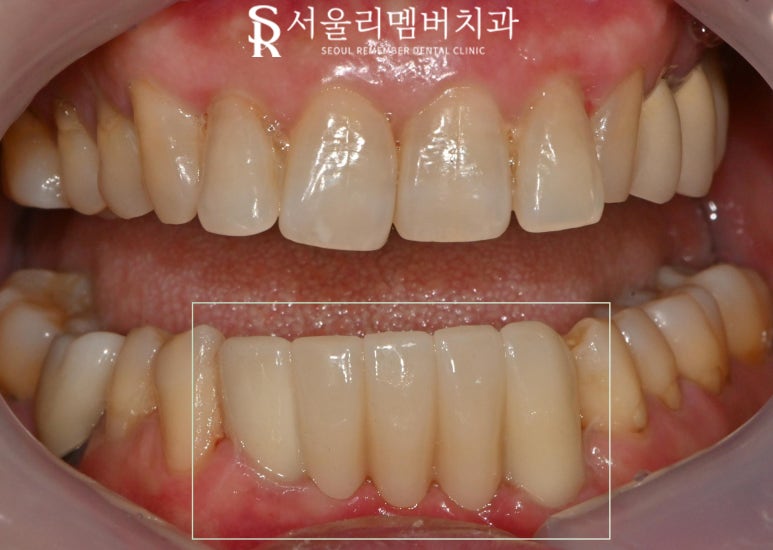Loose Lower Front Teeth, Sillim Station Dental Clinic, Insurance Anssurge Implant for Patients 65 and Older, Minimal Placement, Lower Cost, Faster Completion image 7