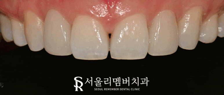 깨져버린 앞니 라미네이트 파절 서울대입구 치과 리얼네이트 심미보철 관련 이미지 2