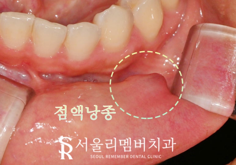 입술에 생긴 볼록한 혹? 관악구 치과 점액낭종(Mucocele) 진단과 제거 치료 방법 관련 이미지 2