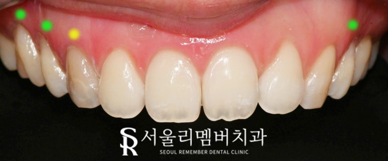치아의 하얀 반점(화이트 스팟 white spot) 서울대입구역 치과 아이콘 레진으로 무삭제 반점치 충치 치료 관련 이미지 8
