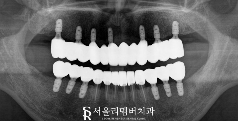 사당 치과 하악 전치 신경치료 브릿지로 살리고 나머지 임플란트로 재건한 전악 증례 관련 이미지 10
