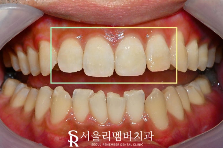 봉천동 치과 위 앞니 상악 4전치 파절 레진 당일 치료 과정, 비용, 견적, 시간 관련 이미지 2