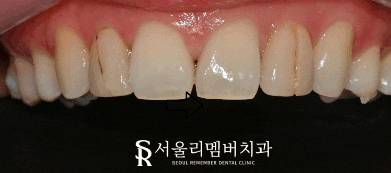 깨져버린 앞니 라미네이트 파절 서울대입구 치과 리얼네이트 심미보철 관련 이미지 1