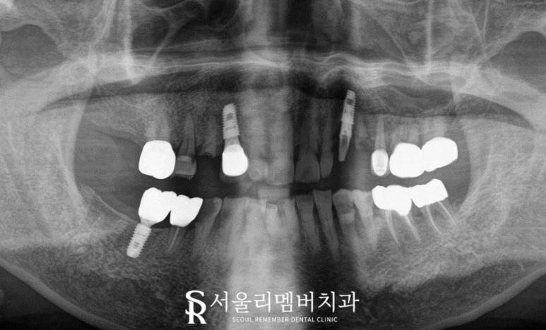 사당역 치과 충치, 치아 흔들림, 파절, 결손, 염증.. 다수의 복합 문제 생겼다면 임플란트 신경치료 크라운 과정 관련 이미지 4