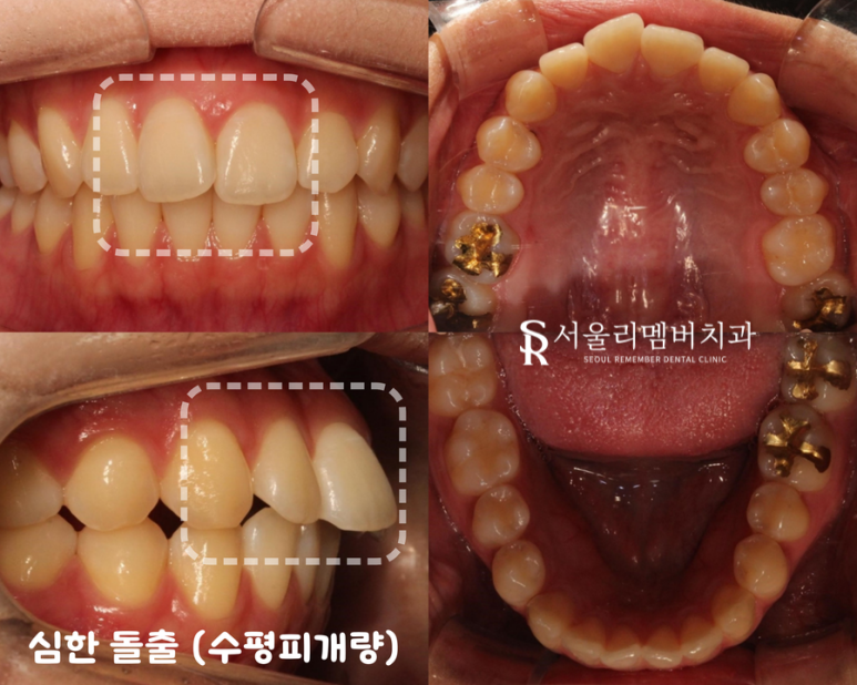 서울대입구역치과 "교정할 때 이를 꼭 뽑아야 되나요?" 돌출입 비발치 개선 관련 이미지 1