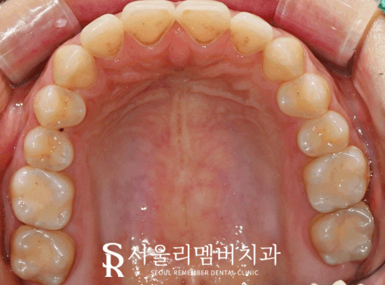 오래된 아말감 신림 치과 수면(의식하 진정) 마취 후 스트라우만 나이스 인레이로 교체 (좌우 2회로 나누어 진행 가능) 관련 이미지 6