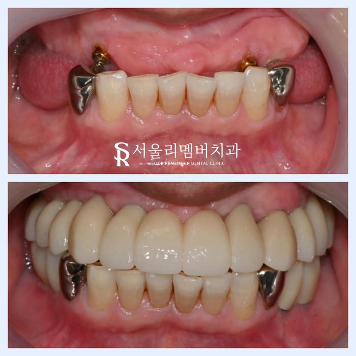 올바른 교합의 중요성, 서울대입구역치과 전체 임플란트 기간 및 과정 관련 이미지 8