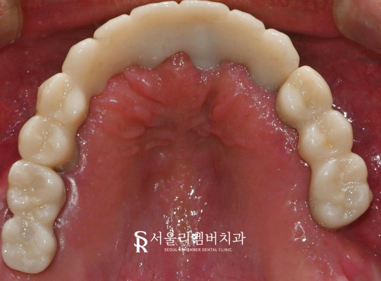 "도저히 음식을 먹지 못해요" 봉천역 치과 수면 임플란트 치료 사례 관련 이미지 5