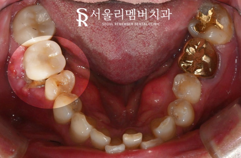 치아 깨지고 통증 있을 때, 서울대입구역 치과 파절 정도에 따른 신경치료 크라운 및 발치 임플란트 관련 이미지 4