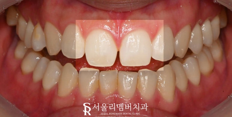 서울대입구역 치과 벌어진 앞니, 다이아스태마 레진 당일 치료 과정 관련 이미지 1