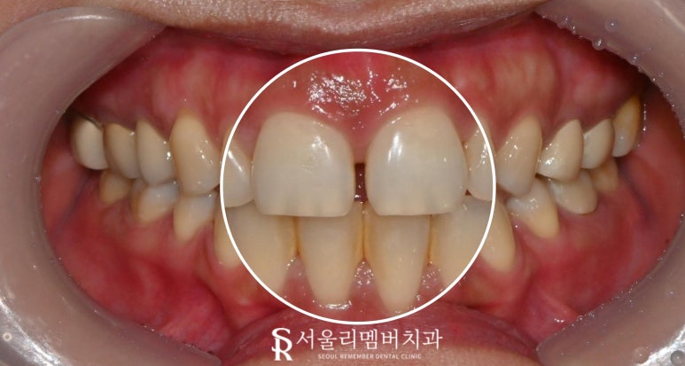 벌어진 앞니 사이 간격 고민이라면 교정? no 라미네이트? yes 서울대입구역치과 관련 이미지 1
