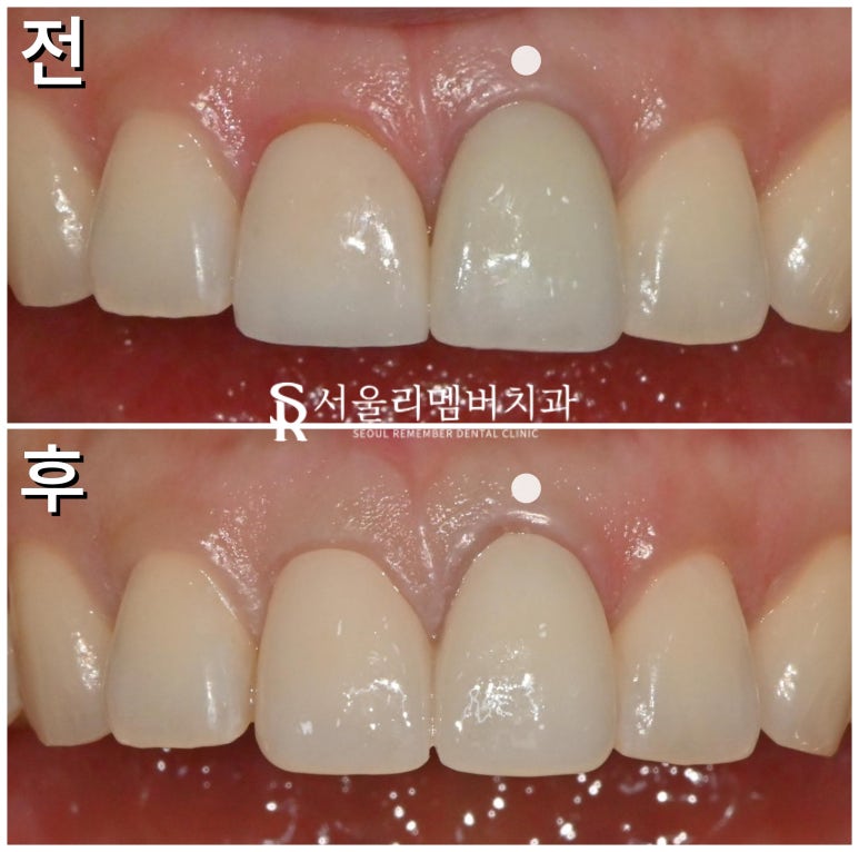 봉천동 치과 위 앞니 크라운 마음에 안 든다면? 상악 중절치 보철 재제작 재치료 과정 관련 이미지 3
