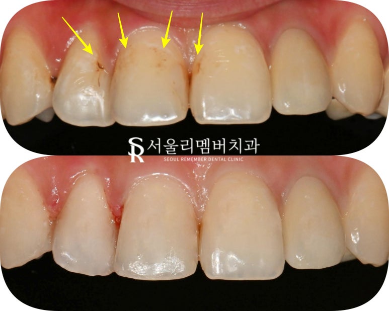 낙성대역 치과 오래된 앞니 레진 변색 및 착색되어 재치료 필요하다면? 관련 이미지 3