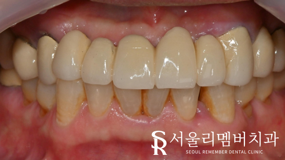 오래된 전체 브릿지 방치하면 이런 문제를 일으킬 수 있습니다. 서울대입구역 치과 풀케이스 치료 과정 관련 이미지 2