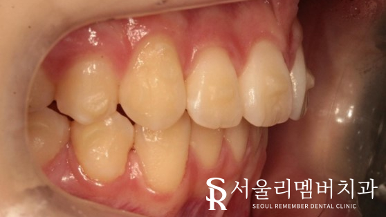 인비절라인을 사용한 치아 총생 개선 증례! 청룡동 치과 관련 이미지 6