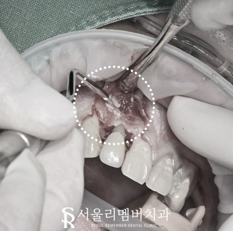 앞니 뿌리 끝 염증, 치근단 절제술(apicoectomy) 보라매 치과 관련 이미지 5