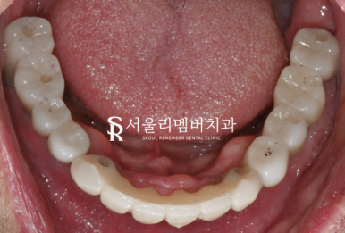여러 곳이 결손된 치아 서울대입구역 치과 에서 다수 임플란트 식립으로 불편감을 개선해 드린 케이스 관련 이미지 8