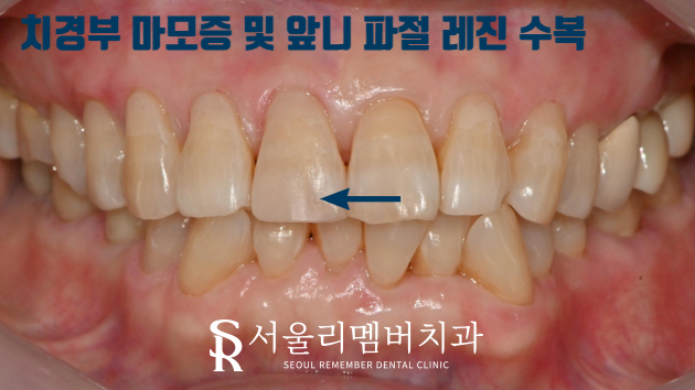 "앞니가 깨졌어요." 서울대입구역 치과 절단연 파절 치료 증례 관련 이미지 2