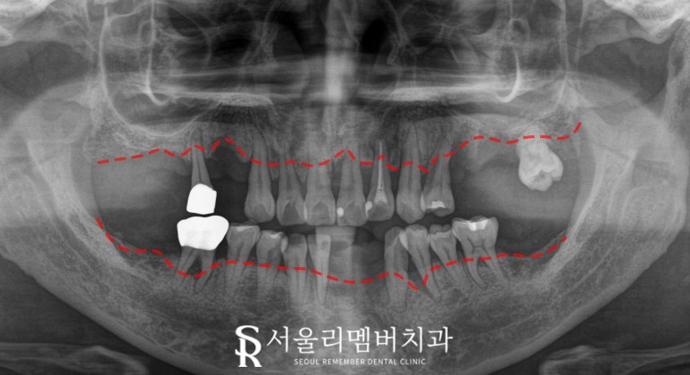 서울대입구역 치과 발치 즉시 다수 네비게이션 임플란트 식립 결과는? 관련 이미지 2