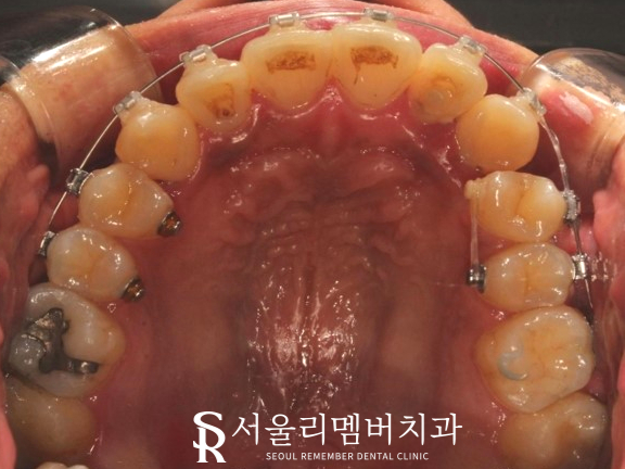 서울대입구역 치과 에서 들쑥날쑥 했던 치열, 비발치로 개선해 드렸습니다. 관련 이미지 5