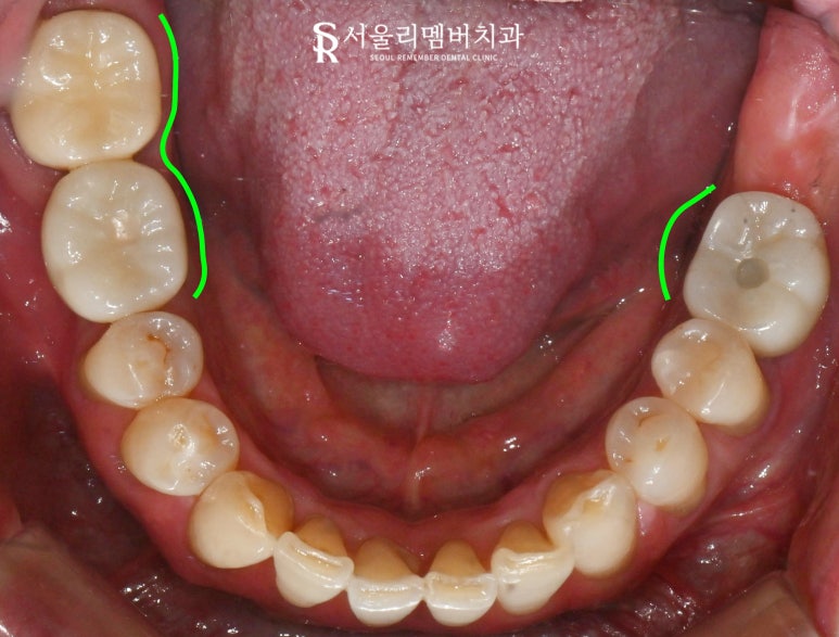 "이제 밥 먹는 것도 문제없어요!" 낙성대 치과 임플란트 로 새로운 구강 환경 찾아 드린 사례 관련 이미지 7