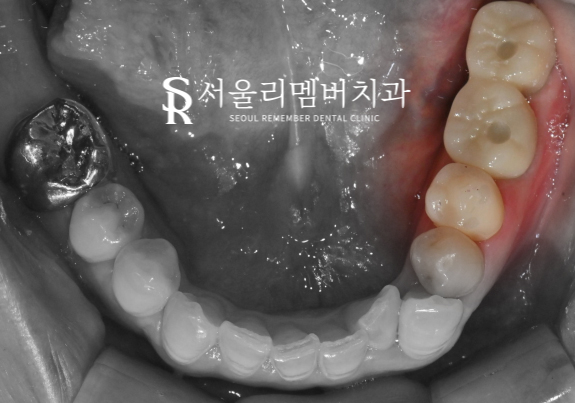 기존 브릿지 주변이 욱신거리고 아파요.. 왜 그런 걸까요? 신대방 치과 임플란트 증례 관련 이미지 4