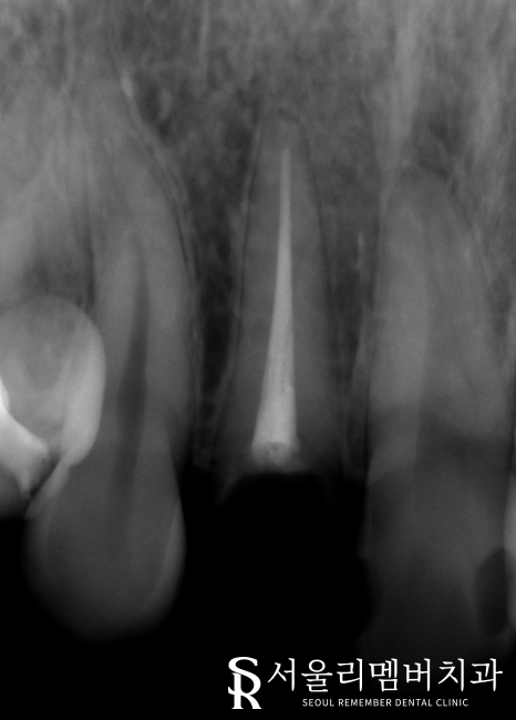 어? 전에 올려놨던 앞니 크라운이 갑자기 떨어졌어요 ! 신길동 치과 관련 이미지 2