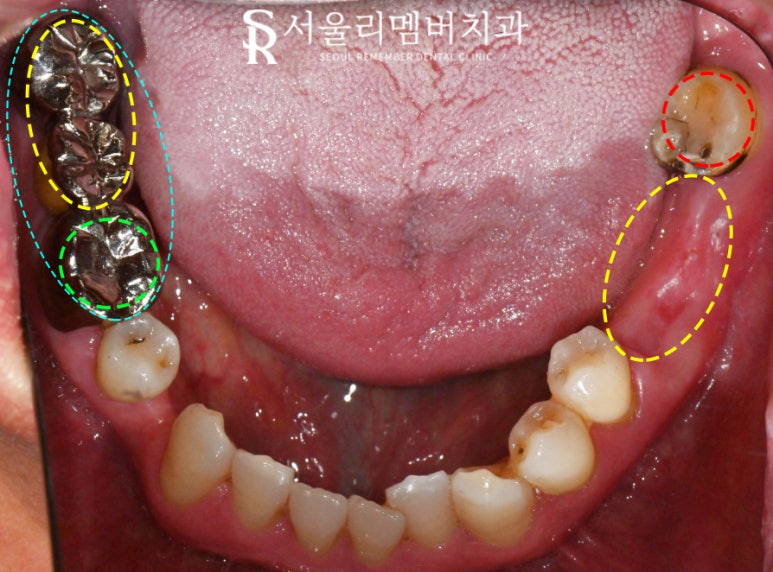 신림역 치과, 어금니 임플란트 및 보철 치료로 심미 저작 기능 개선 과정 관련 이미지 3