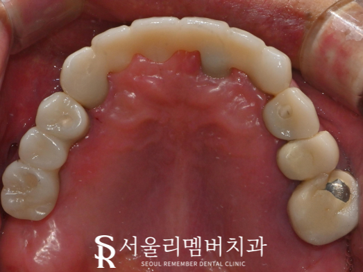 오래된 전체 브릿지 방치하면 이런 문제를 일으킬 수 있습니다. 서울대입구역 치과 풀케이스 치료 과정 관련 이미지 6
