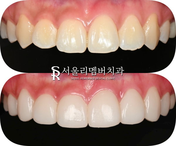 사당역 치과 리얼네이트 심미보철 라미네이트로 누렇고 약한 앞니부터 작은 어금니까지 변화 관련 이미지 8