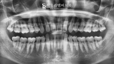 상도동치과 에서 발치 없이 깊게 물리는 과개교합 및 2급 부정교합 개선! 관련 이미지 4