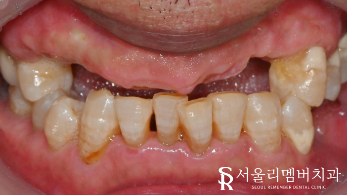 신림역 치과 임플란트 식립 시 어떤 것을 우선적으로 고려하는 것이 좋을까? 관련 이미지 1