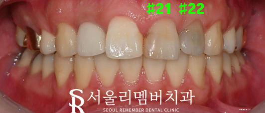 앞니 변색 이유는? 사당 치과 충치치료 로 환한 미소 되찾는 방법 관련 이미지 1