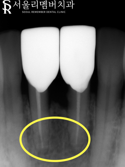 보라매역 치과 신경치료 및 크라운으로 기능과 외관 되살리기. 관련 이미지 6