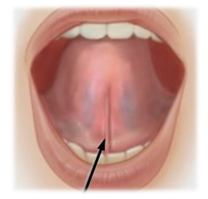 혀가 짧다? 설소대 절제술로 해결할 수 있습니다. 봉천동 치과 관련 이미지 1