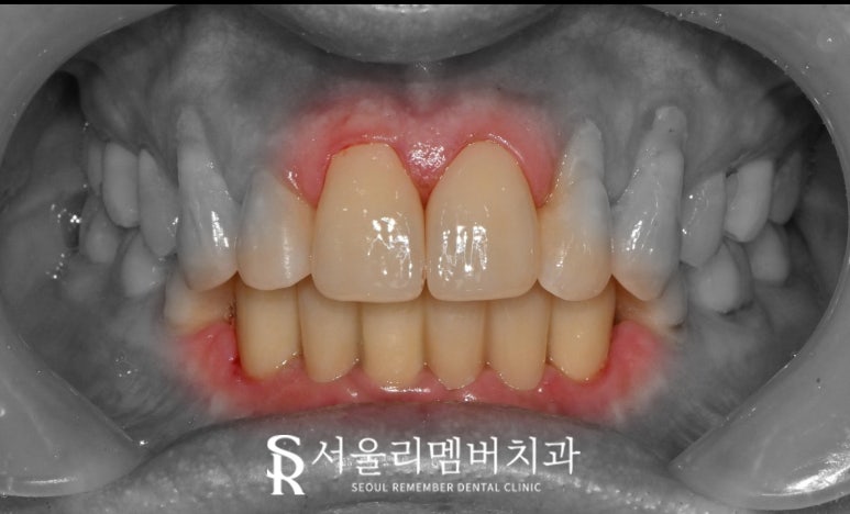 신림역 치과 앞니 크라운 및 임플란트 필요할 때 고려해야 될 요소 (비용, 기간, 개수 etc) 관련 이미지 3